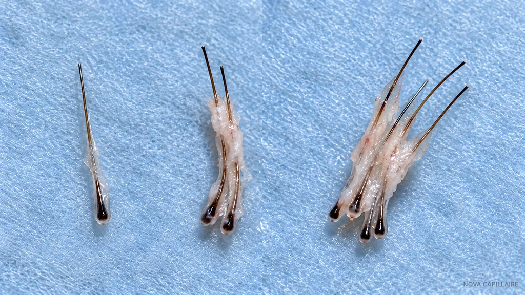 One hair and grafts with two and four hairs — NOVA From left to right: one isolated hair, a two-hair graft and a four-hair graft on a blue background.