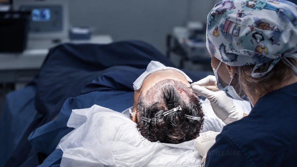 Graft implantation in the frontal area at NOVA.
