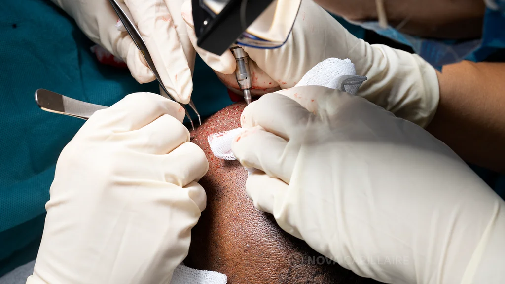 Greffe de cheveux crépus : geste opératoire en vue rapprochée Mains gantées et instruments au contact du cuir chevelu pendant une greffe de cheveux crépus.