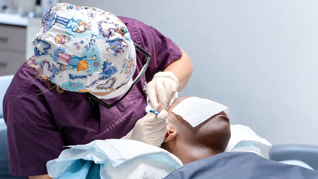 Greffe de cheveux crépus — préparation du tracé frontal Une membre de l’équipe trace les repères frontaux d’un patient avant une greffe de cheveux crépus.