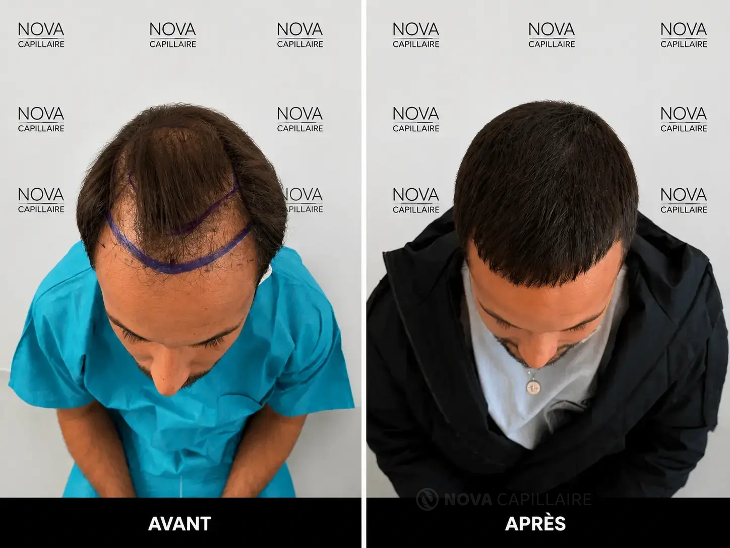 Avant, patient 5, greffe de 6000 greffons