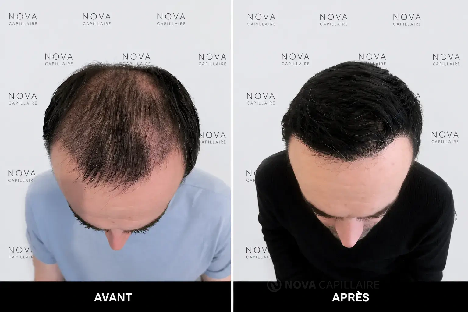 Avant, patient 31, greffe de 6000 greffons