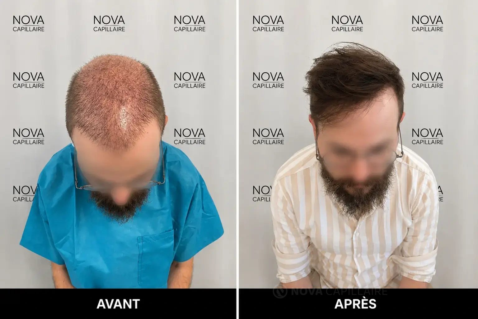 Avant, patient 13, greffe de 4200 greffons