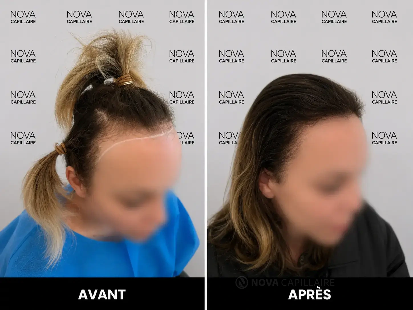 Avant, patient 17, greffe de 2000 greffons
