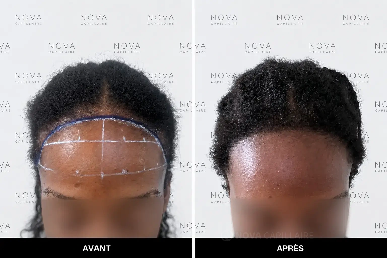 Avant, patient 10, greffe de 1500 greffons