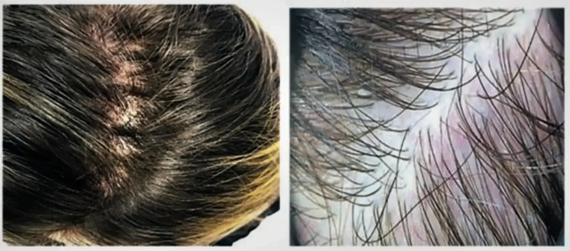 Clinical illustration of diffuse hair loss and density observation by trichoscopy