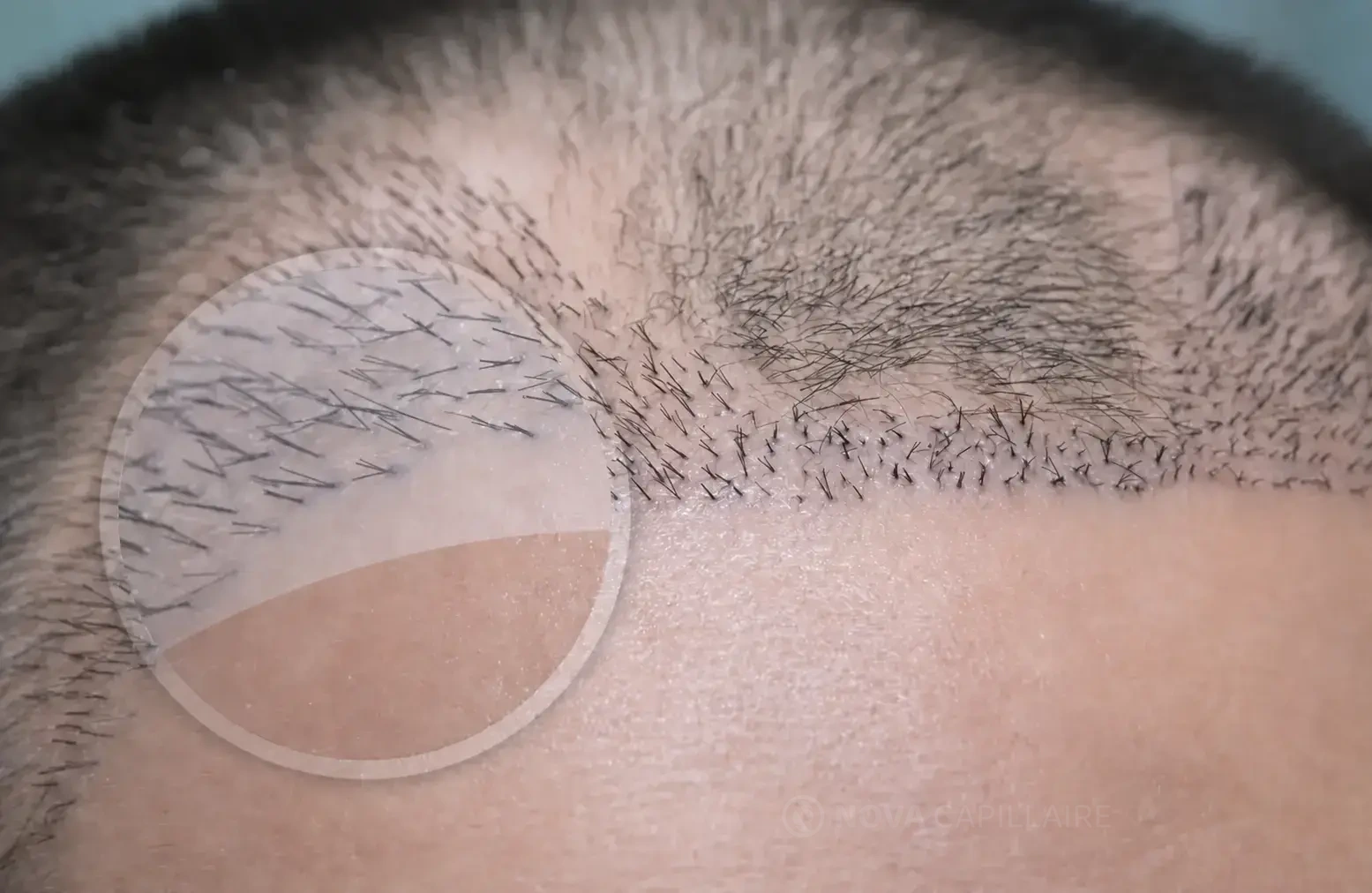 Hairline after hair transplant showing multiple grafts implanted too close to the frontal edge