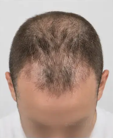 Month 1: NOVA regrowth series