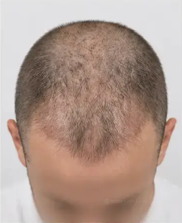 Month 3: NOVA regrowth series