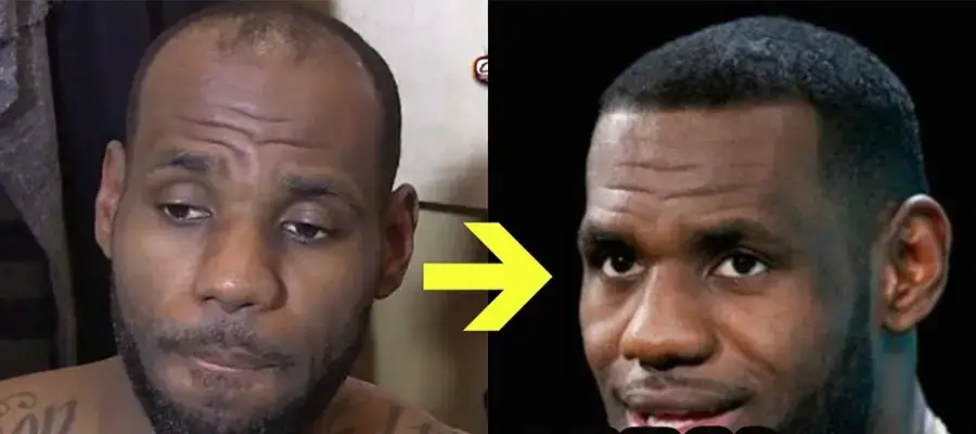 LeBron James et les rumeurs de greffe de cheveux