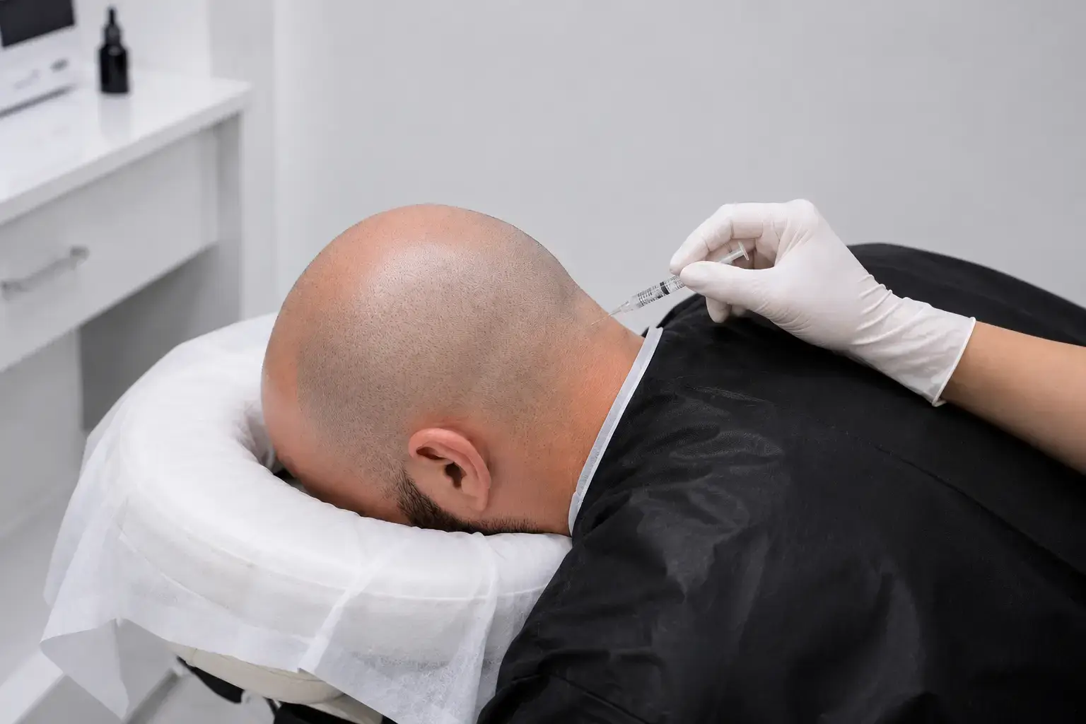 Anesthésie locale avant une greffe de cheveux FUE Saphir