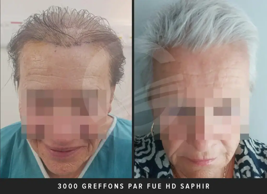 Greffe de cheveux 3000 greffons