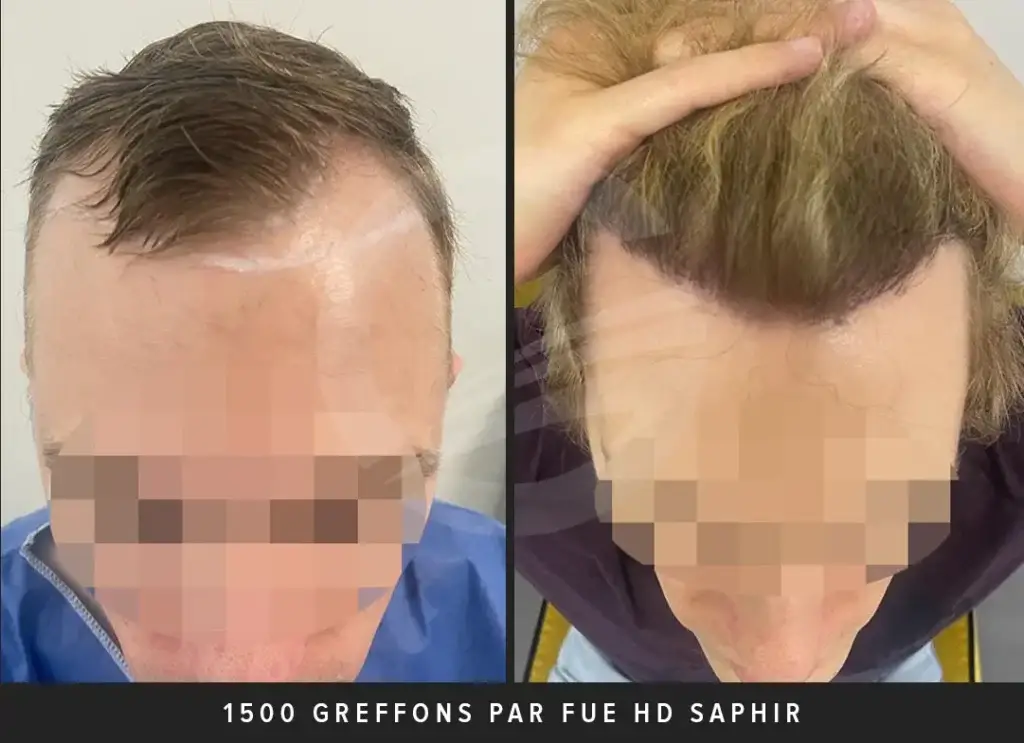 Greffe de cheveux 1500 greffons