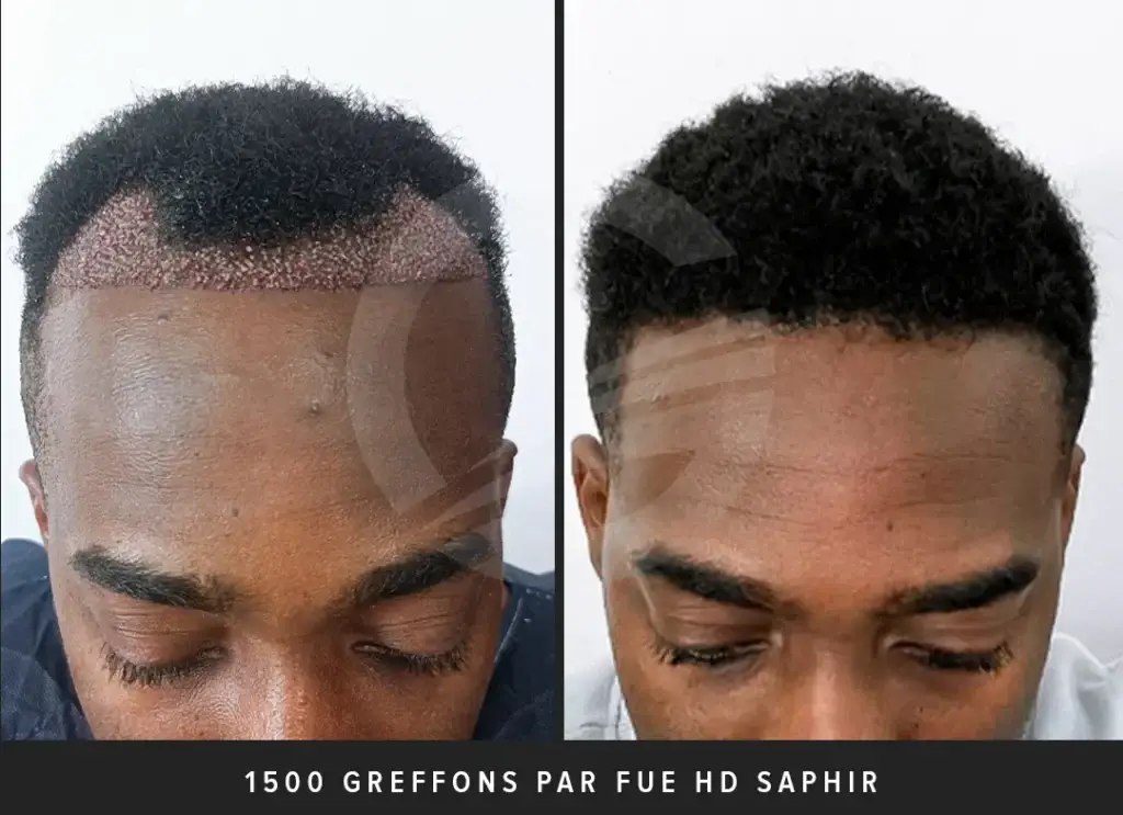 Greffe de cheveux crépus 2000 greffons