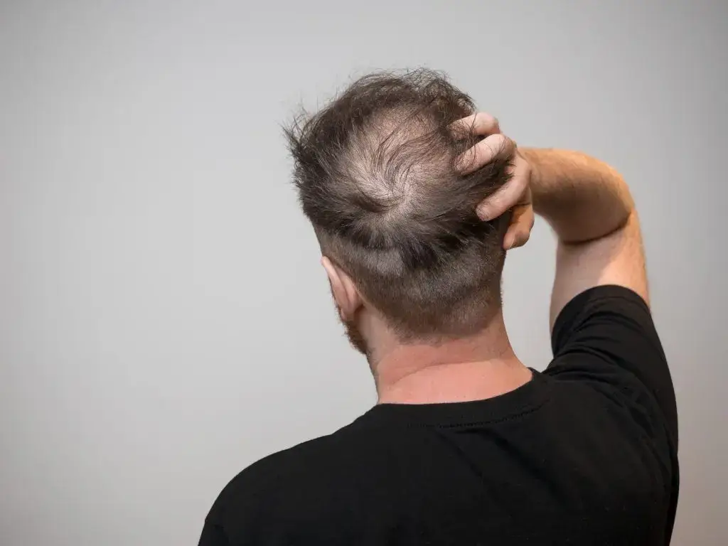 Pourquoi les cheveux donneurs sont-ils prélevés à l’arrière de la tête ?