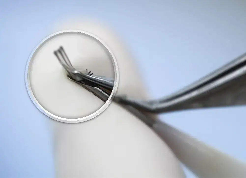 Greffon à trois cheveux maintenu par des micro-pinces à l’entrée d’une aiguille de stylo implanteur Choi