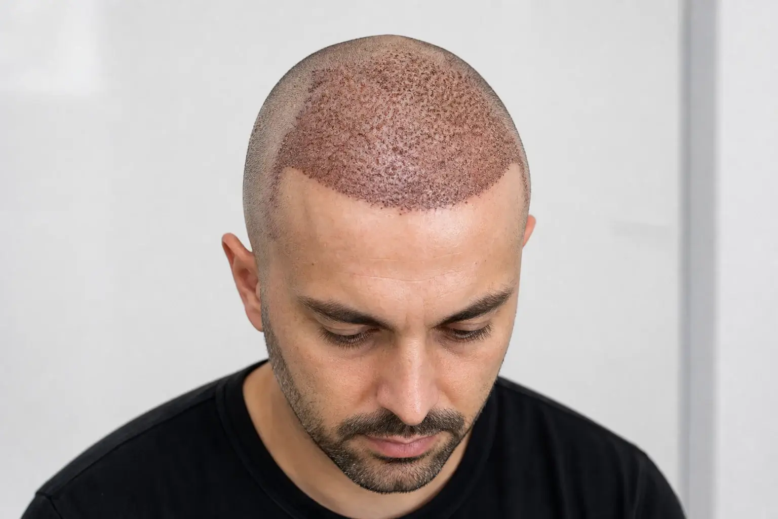 Petites croûtes visibles sur la zone greffée après une greffe de cheveux FUE