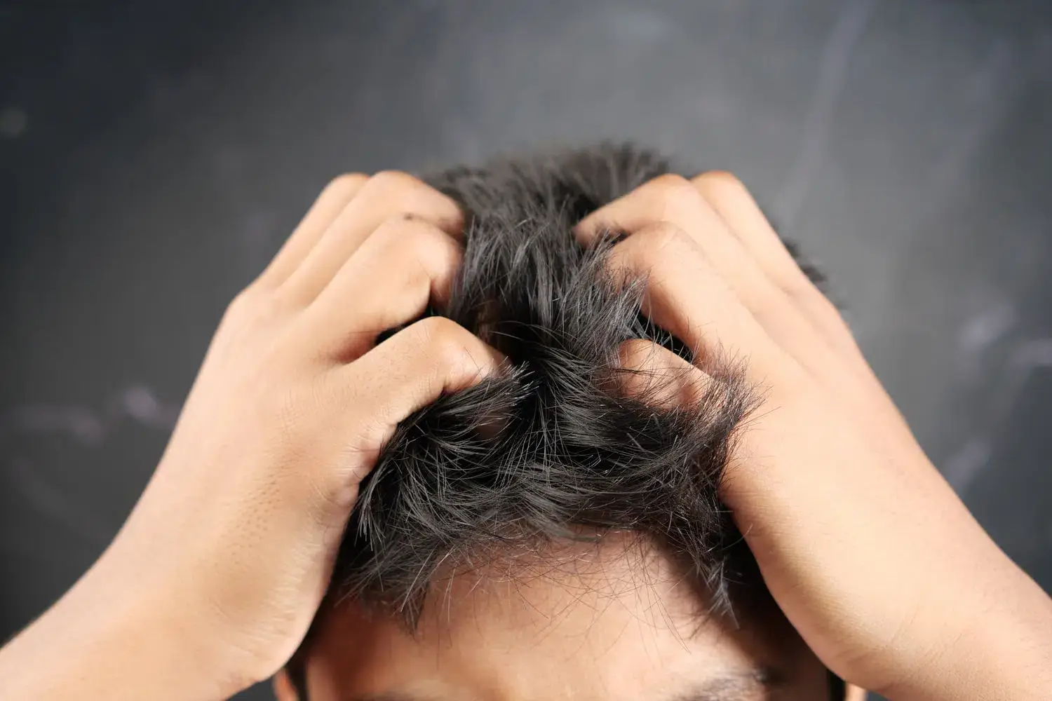 Démangeaisons après une greffe de cheveux