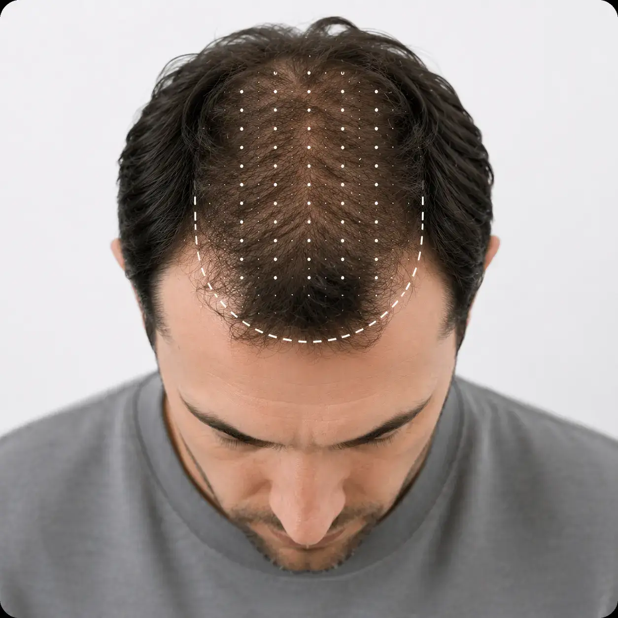 Évaluation de la densité des cheveux sur le dessus du cuir chevelu