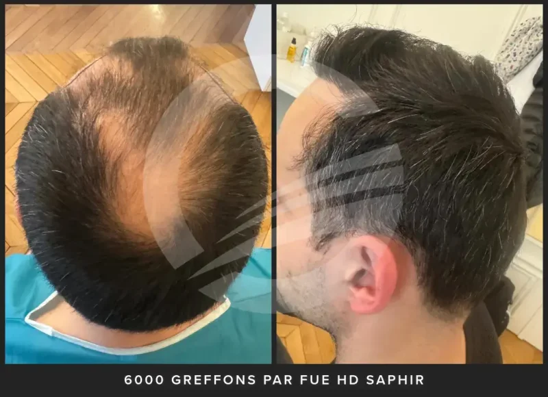 Greffe de cheveux 6000 greffons