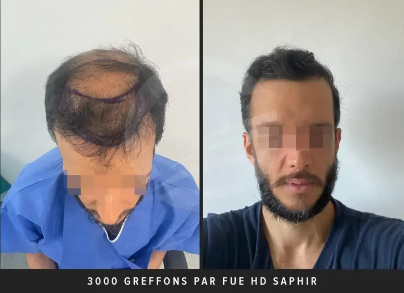 Greffe de cheveux crépus 3000 greffons