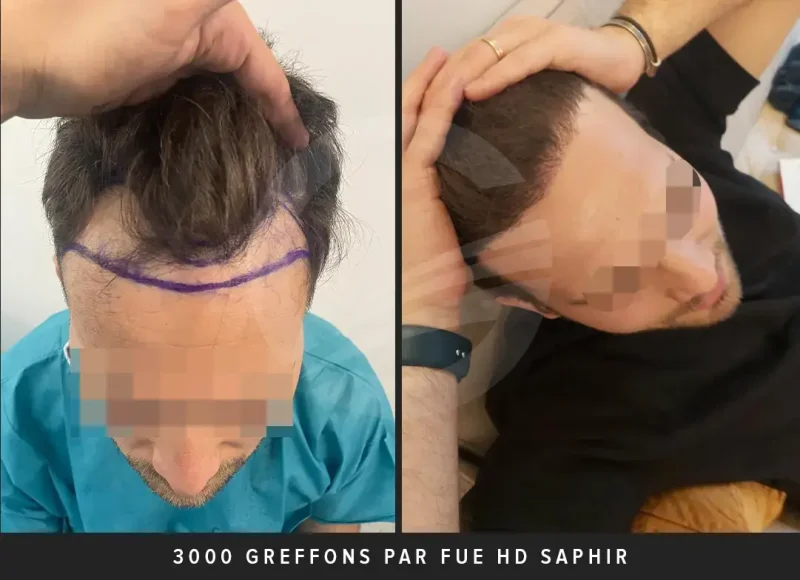 Greffe de cheveux 3000 greffons