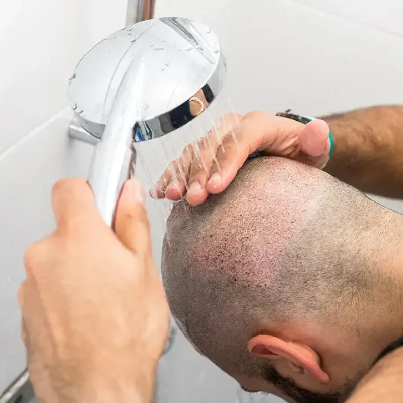 Les shampoings après une greffe de cheveux