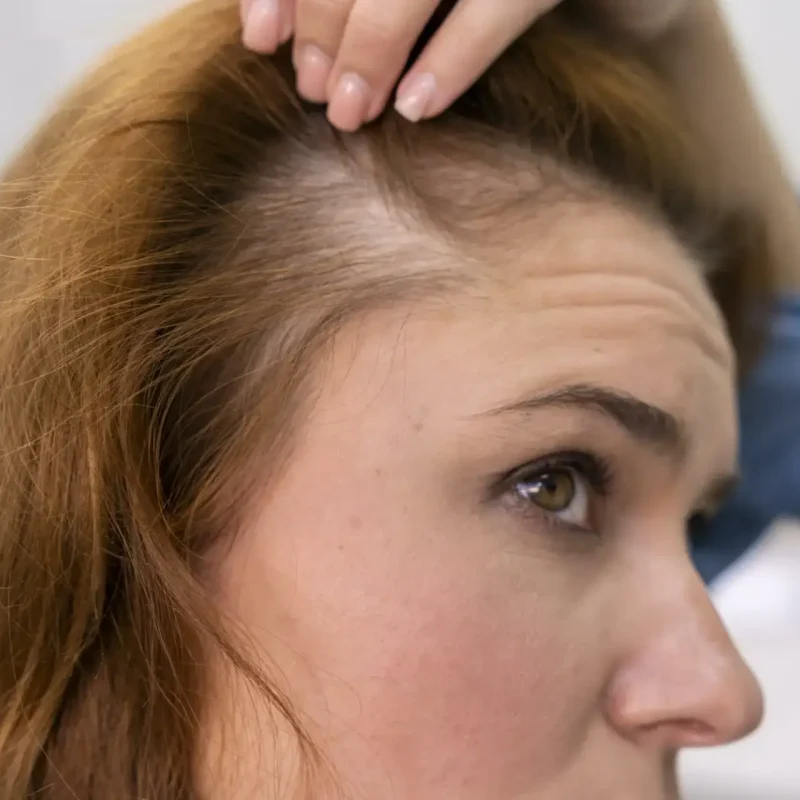 Perte de cheveux au niveau du front chez les femmes