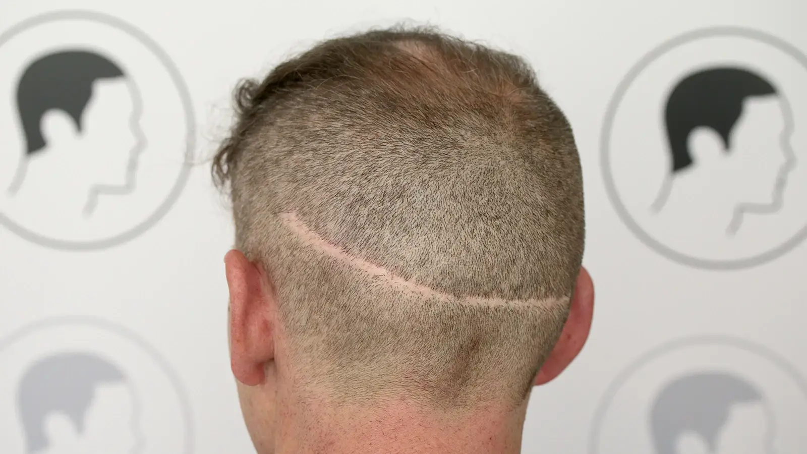 Cicatrice visible après une FUT (Follicular Unit Transplantation)