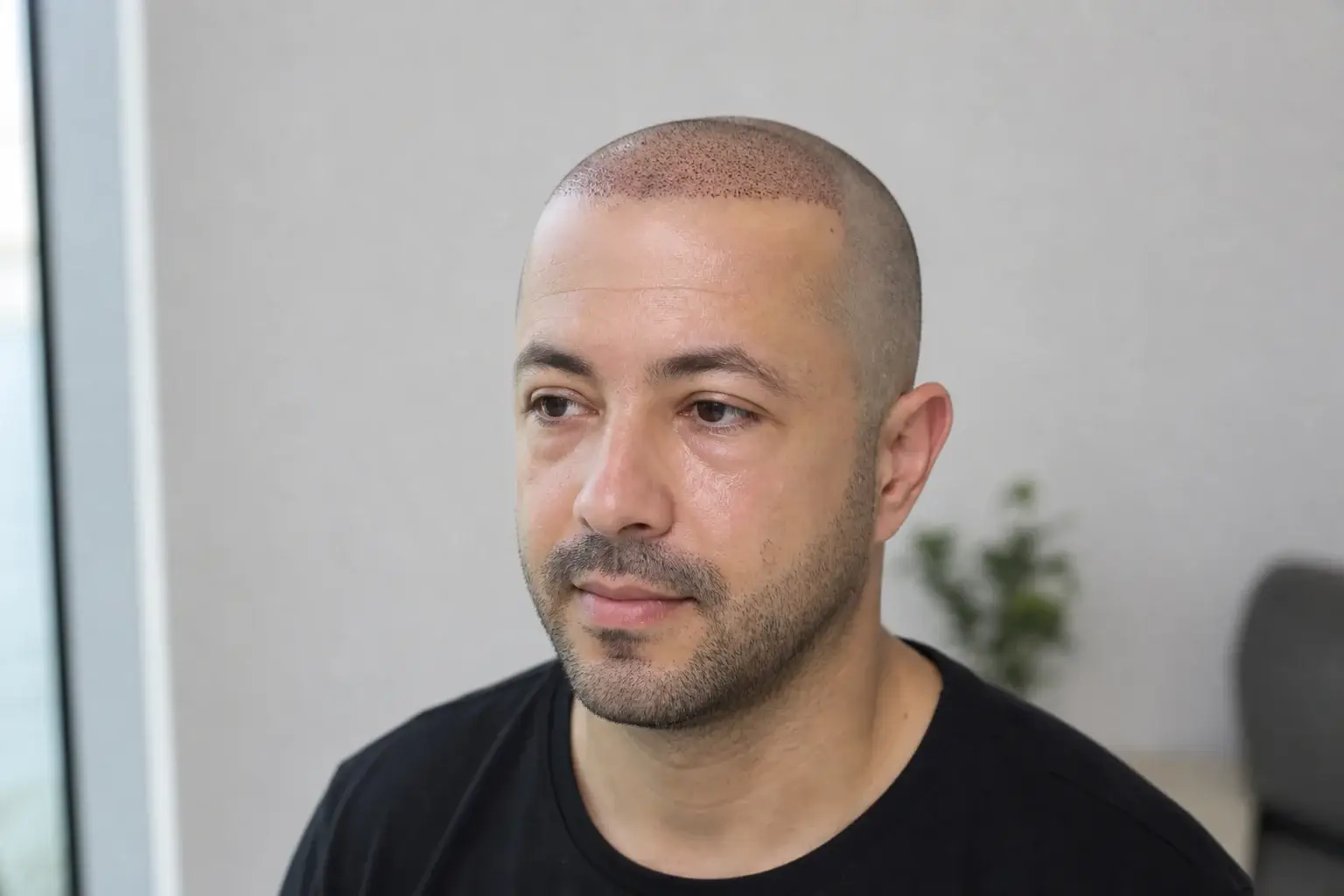 Soins après greffe de cheveux : gonflement léger du front et du contour des yeux