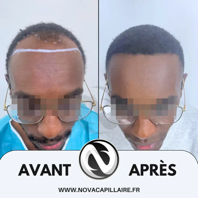 Greffe de cheveux avant après