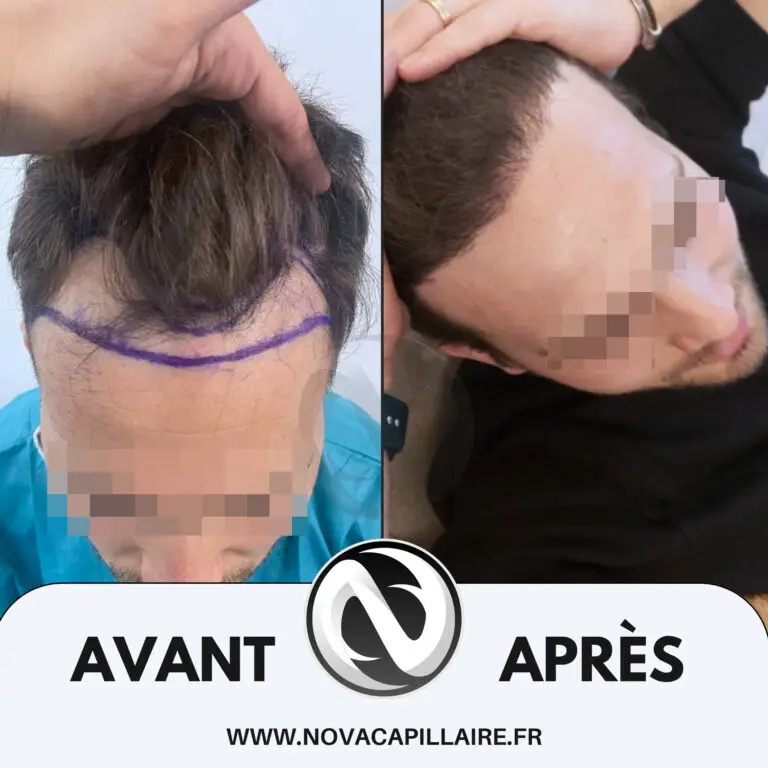 Greffe de cheveux avant après