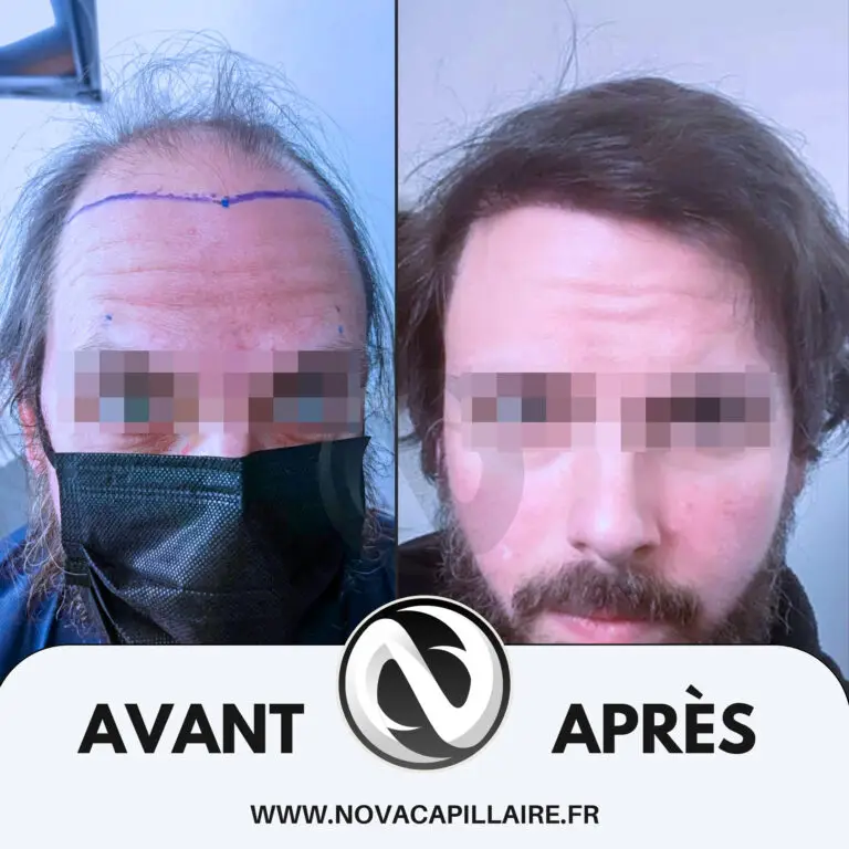 Greffe de cheveux avant après