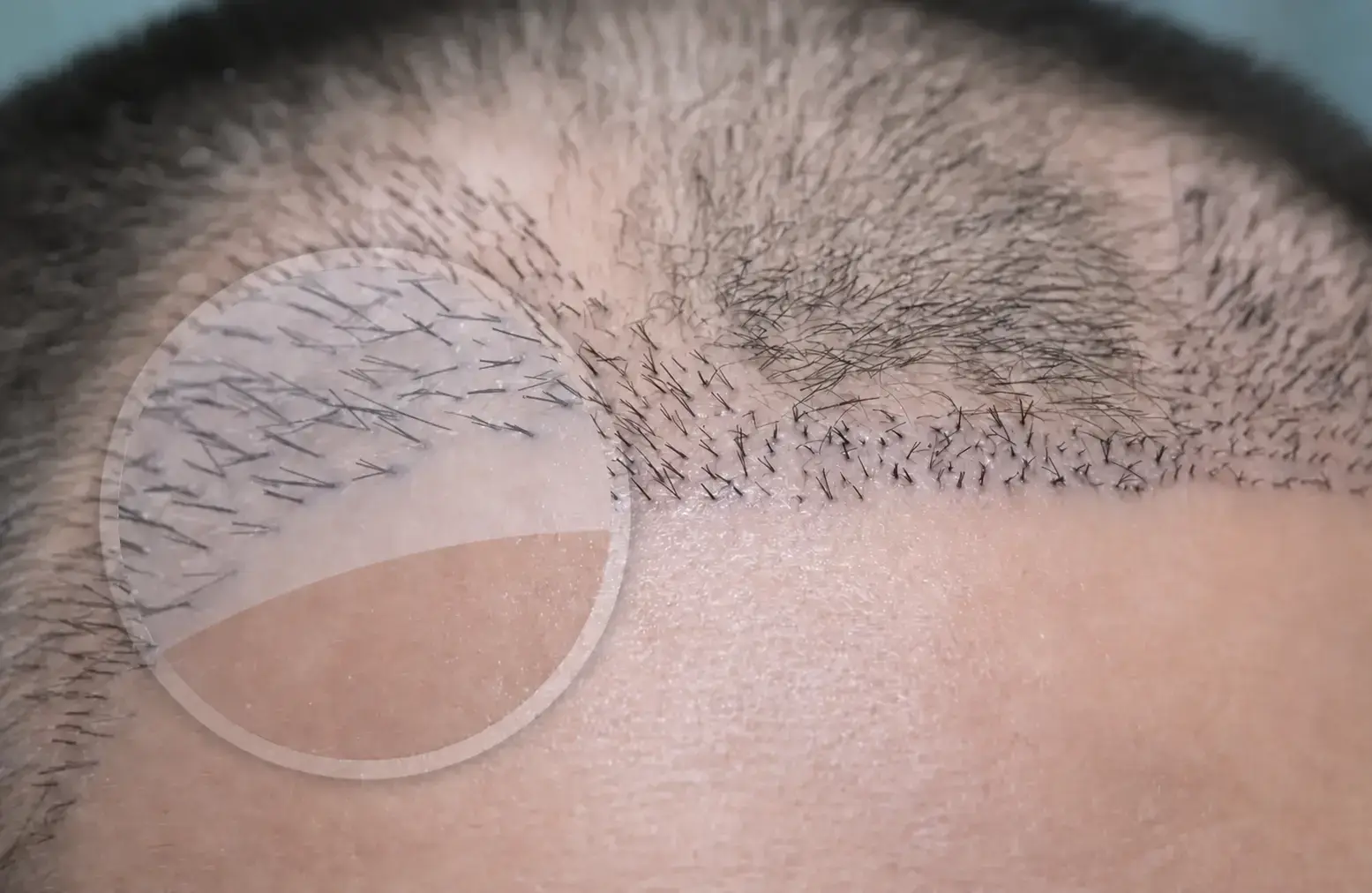 Ligne frontale après greffe capillaire montrant des greffons multiples implantés trop près du bord frontal