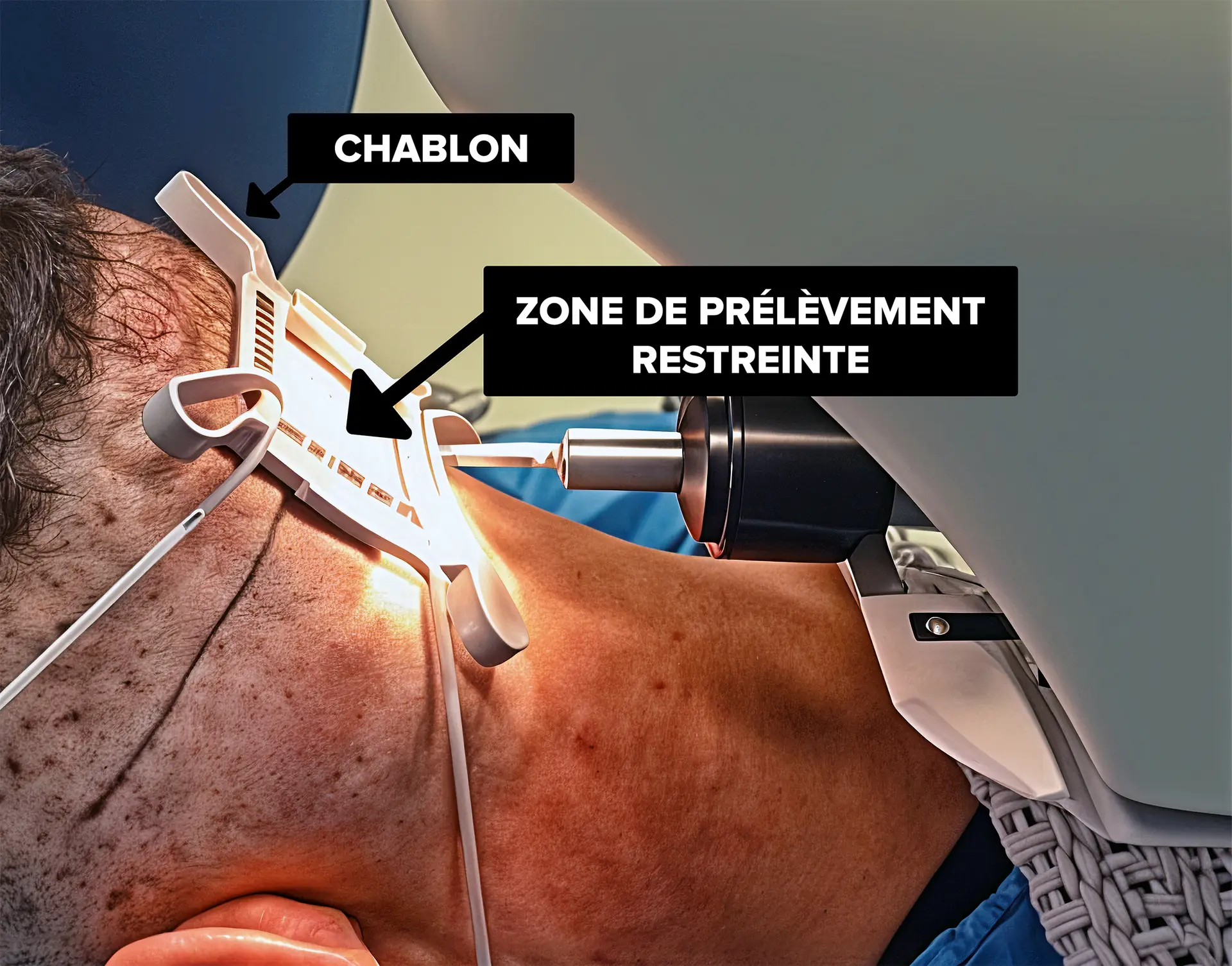 Illustration montrant le placement du chablon utilisé lors d’une greffe de cheveux robotisée. On y voit clairement com