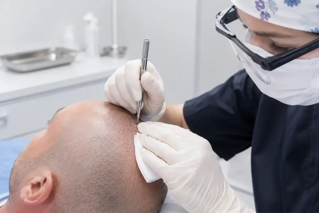 Implantation des greffons avec la technique FUE Saphir