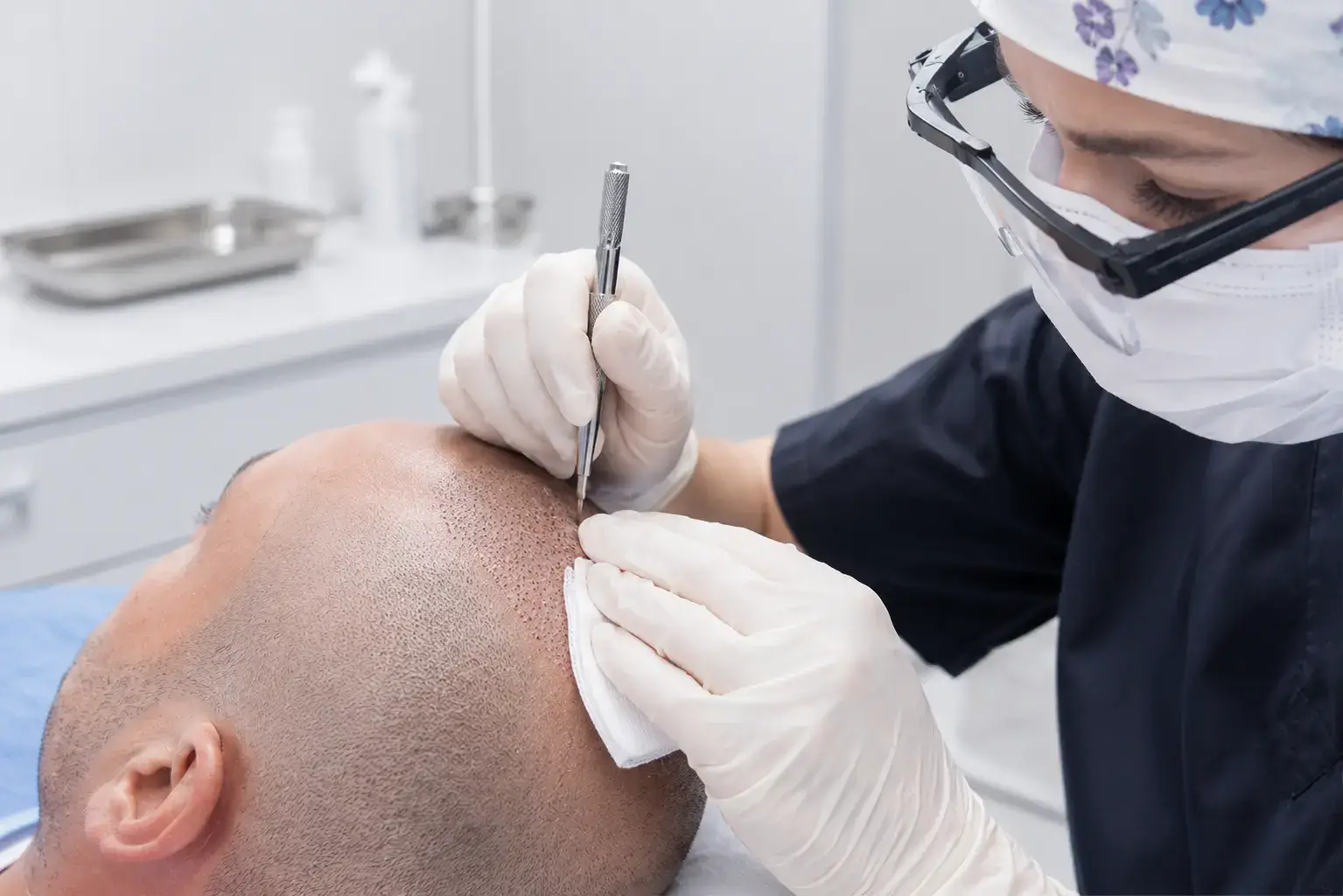 Implantation des greffons avec la technique FUE Saphir