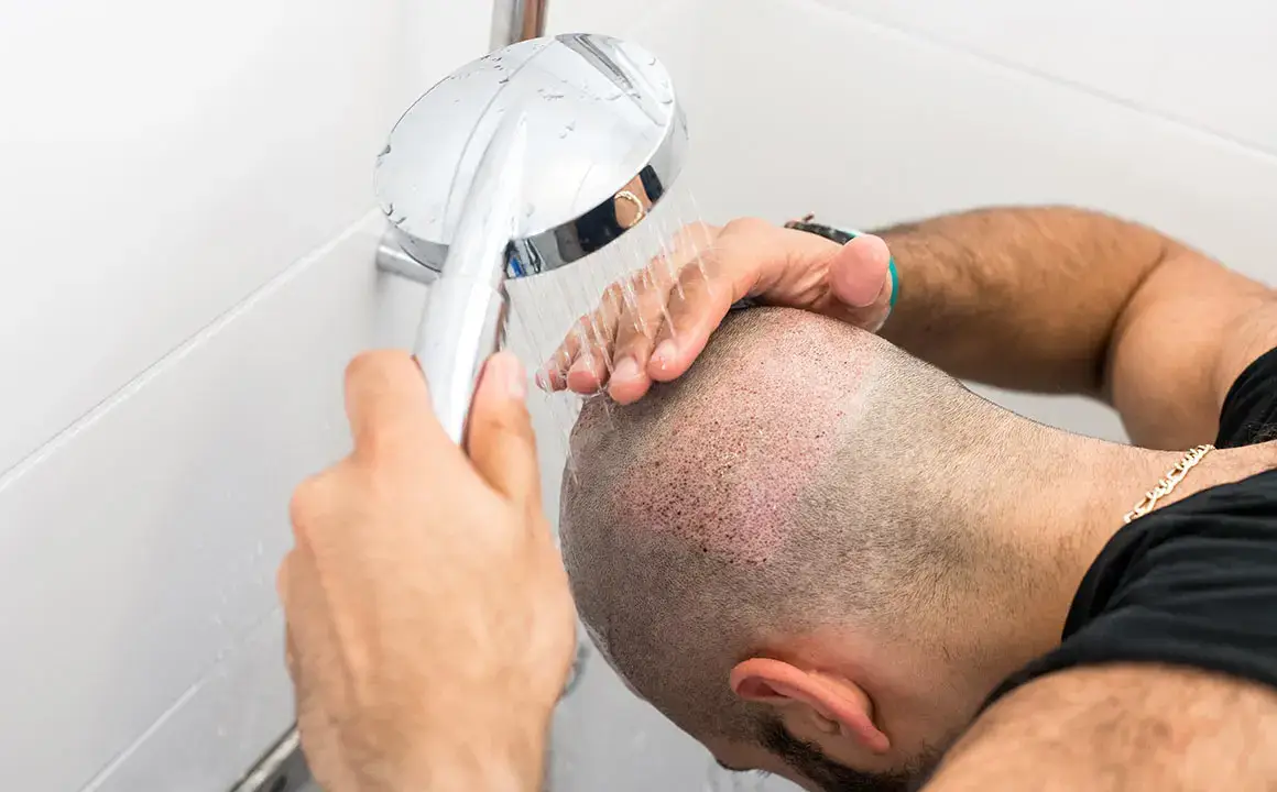 Les shampoings après une greffe de cheveux