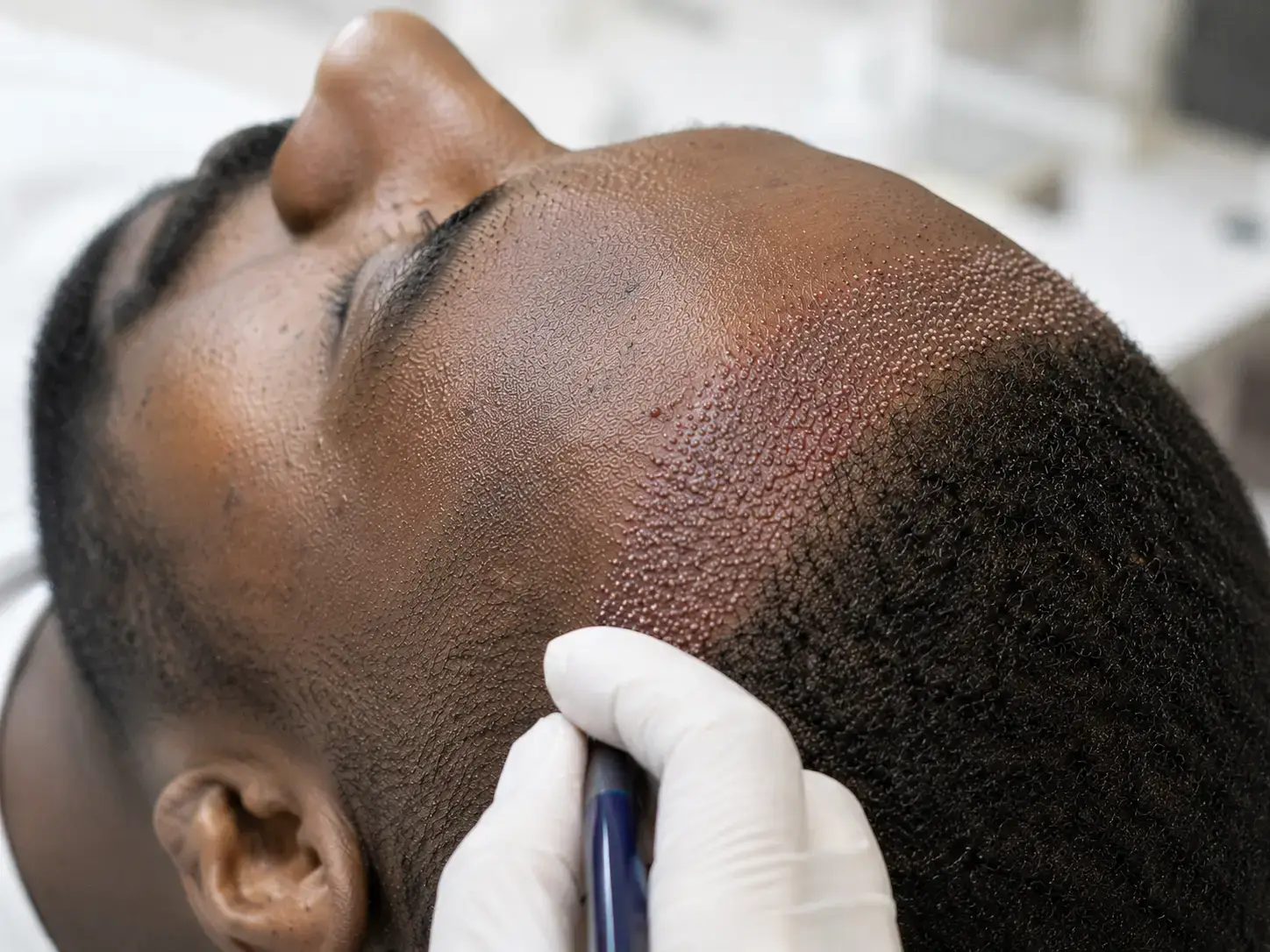 Greffe de cheveux crépus et afro à Paris