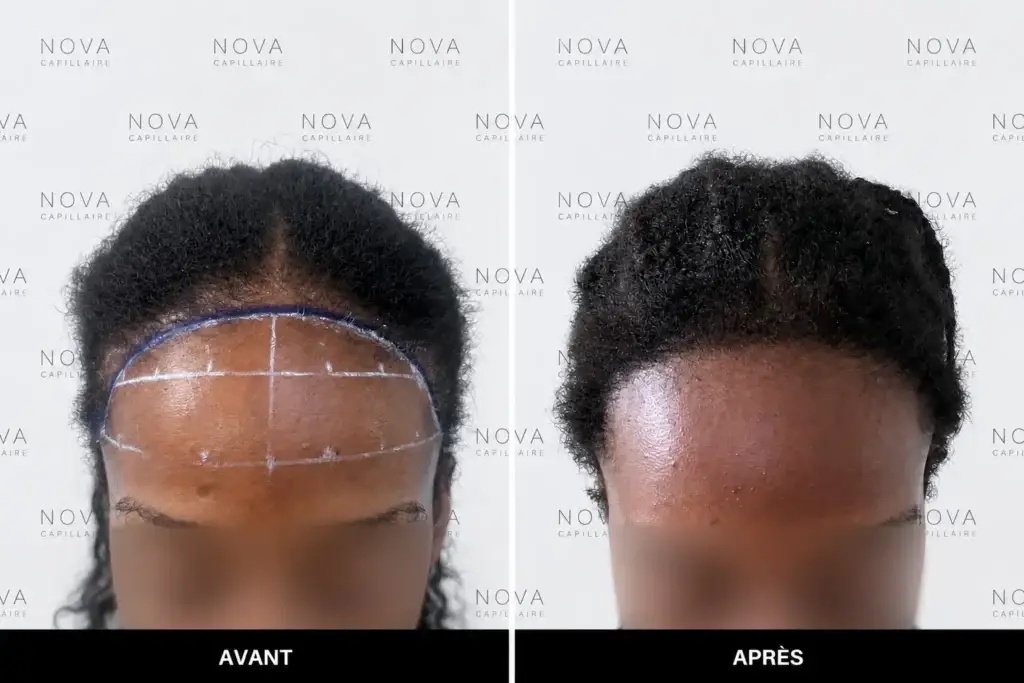 Comparaison avant-après montrant la repousse après une greffe de cheveux — cas 1