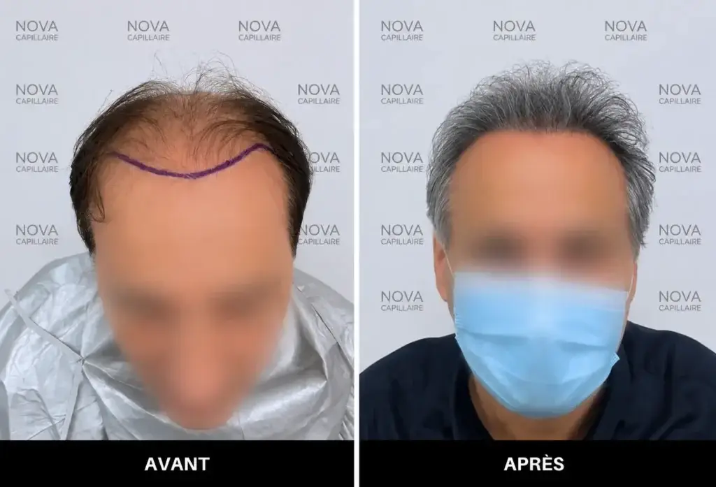 Comparaison avant-après montrant la repousse après une greffe de cheveux — cas 10