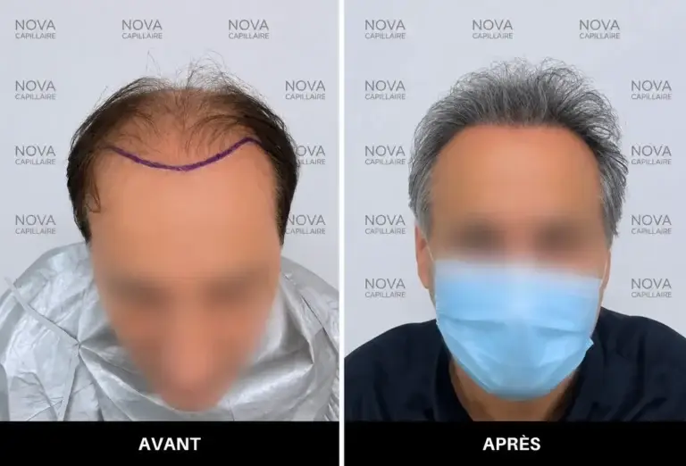 Comparaison avant-après montrant la repousse après une greffe de cheveux — cas 10