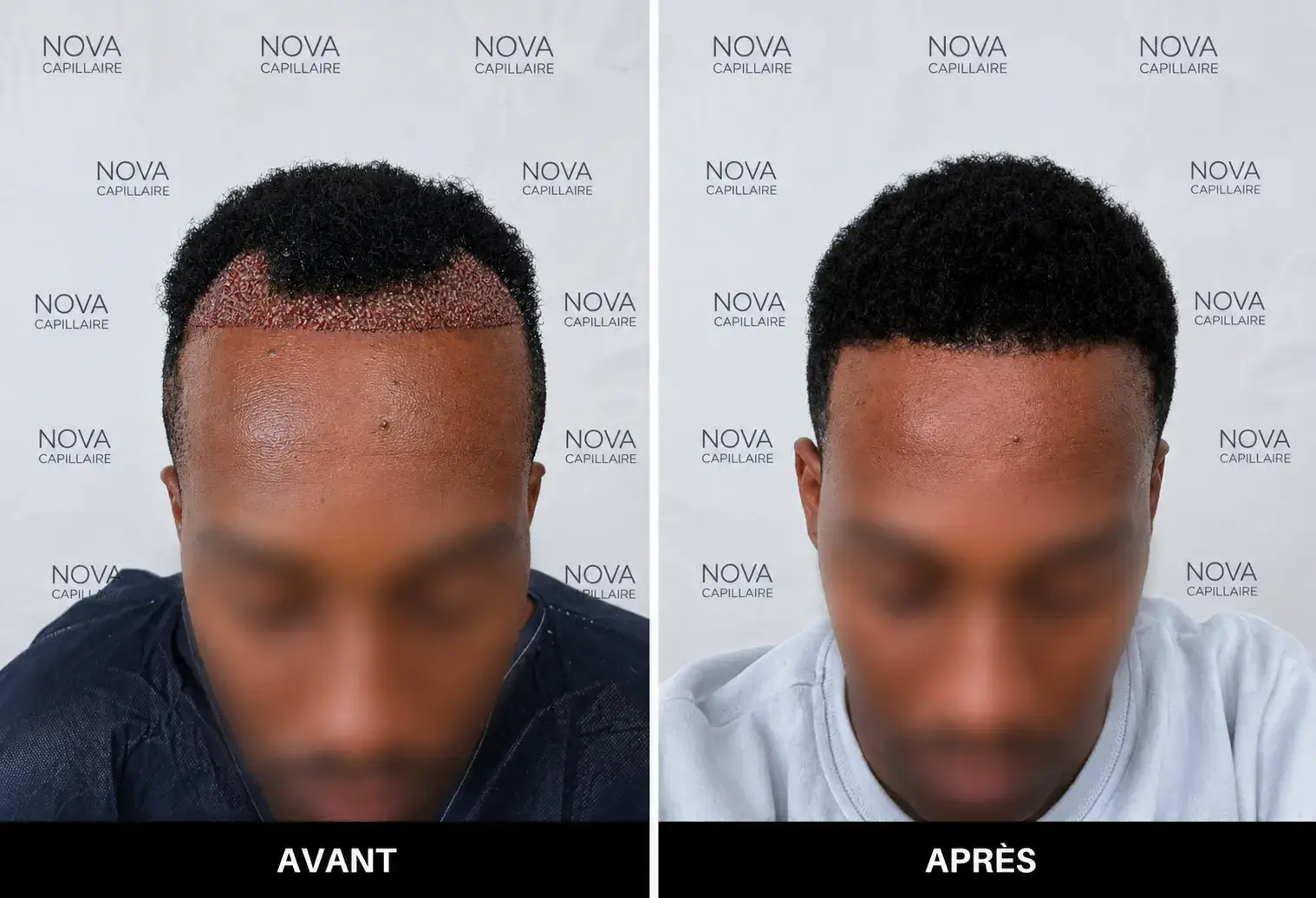 Comparaison avant-après montrant la repousse après une greffe de cheveux — cas 11