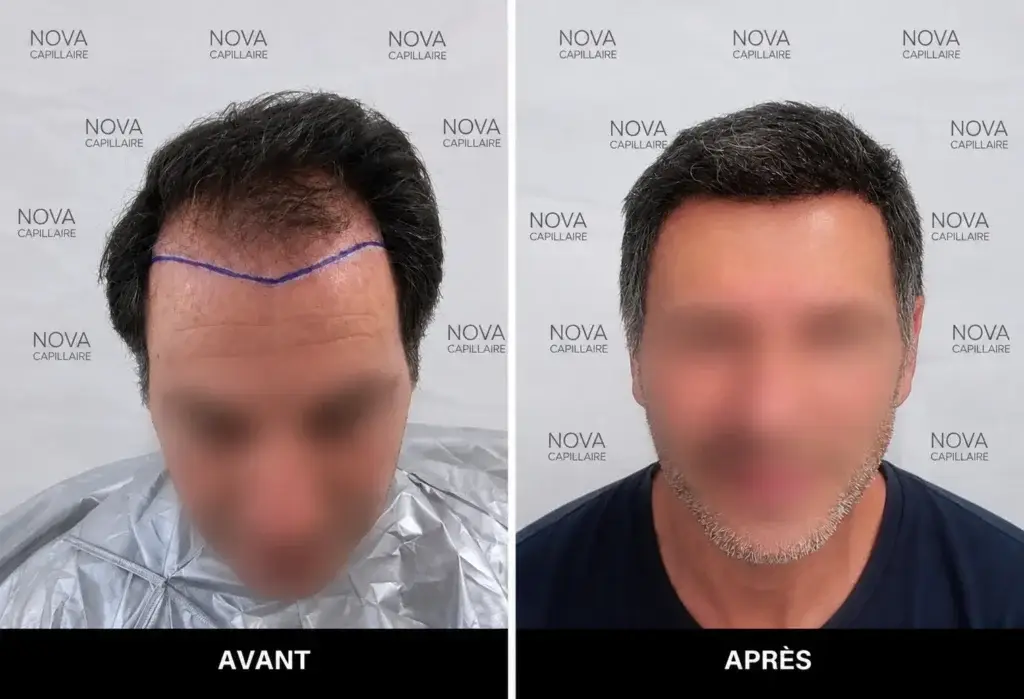 Comparaison avant-après montrant la repousse après une greffe de cheveux — cas 12