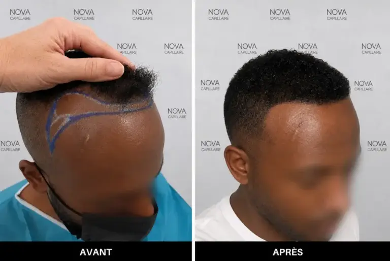 Comparaison avant-après montrant la repousse après une greffe de cheveux — cas 13