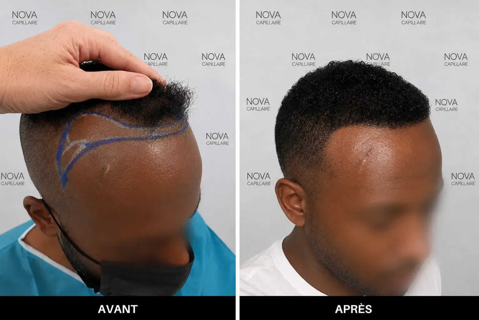Comparaison avant-après montrant la repousse après une greffe de cheveux — cas 13