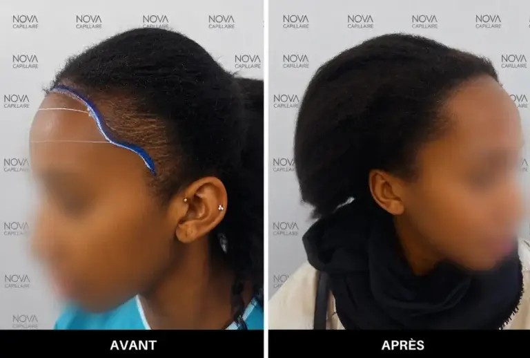 Comparaison avant-après montrant la repousse après une greffe de cheveux — cas 14