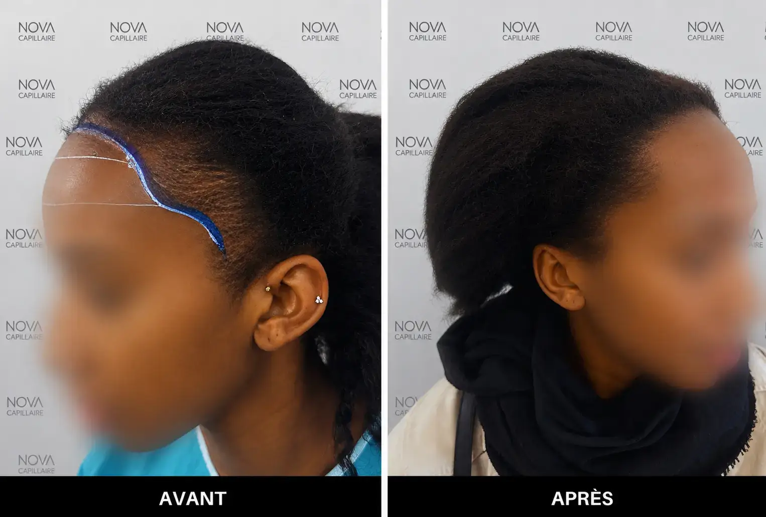 Comparaison avant-après montrant la repousse après une greffe de cheveux — cas 14
