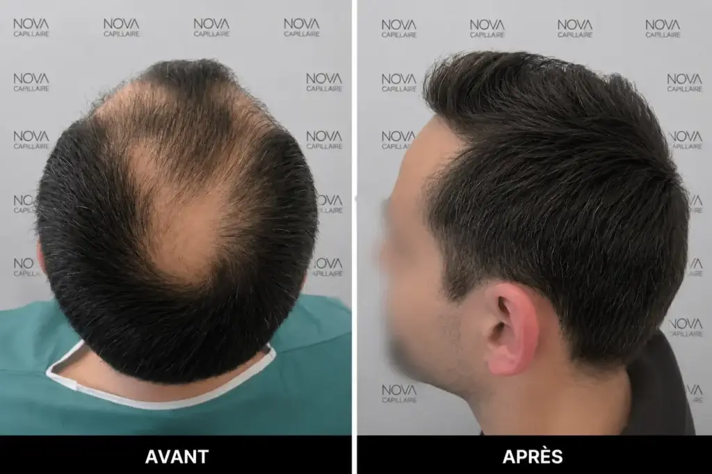 Comparaison avant-après montrant la repousse après une greffe de cheveux — cas 16