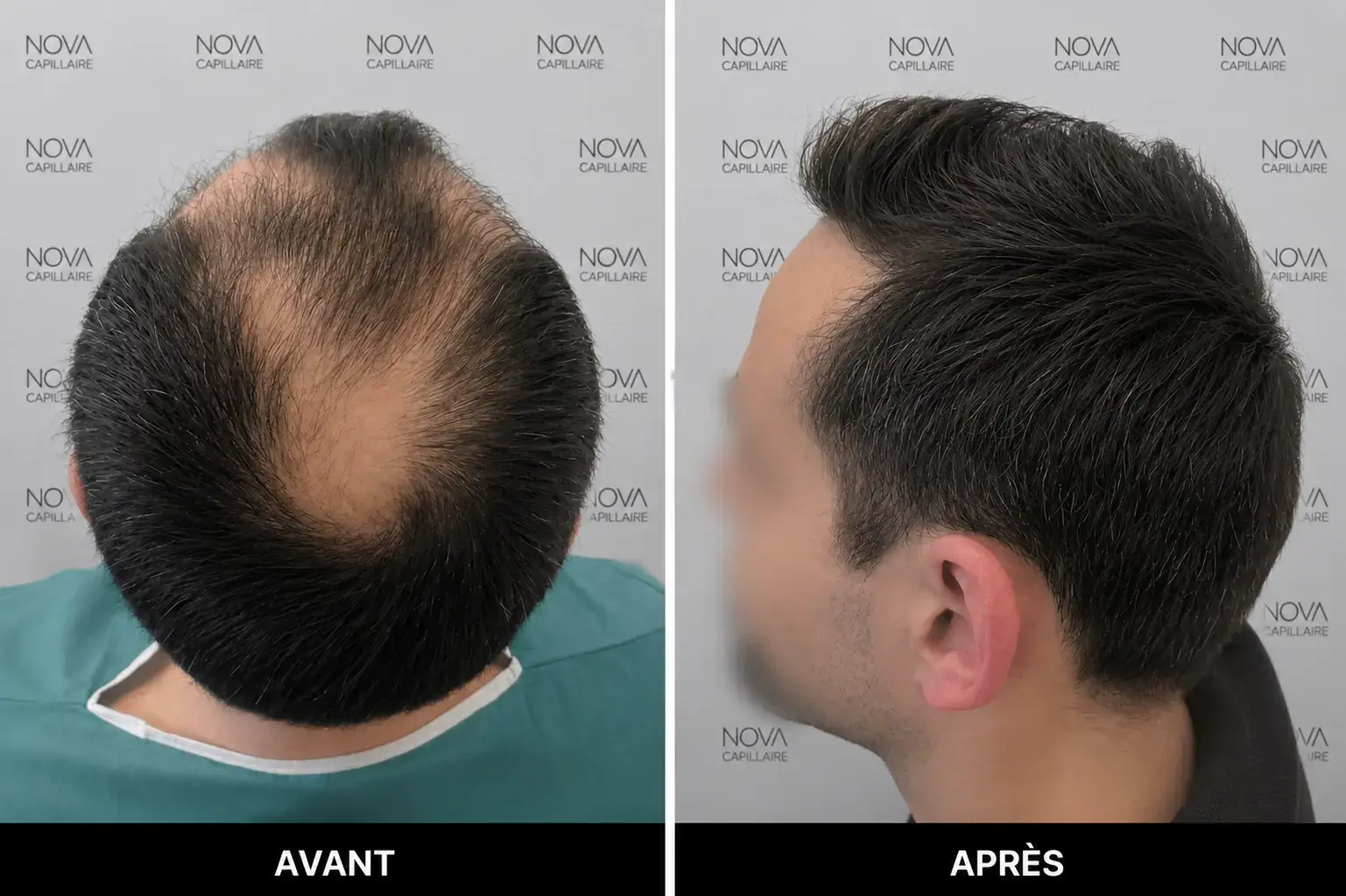 Comparaison avant-après montrant la repousse après une greffe de cheveux — cas 16